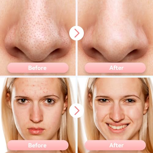 Blackhead Remover Pore Vacuum Electric Comedone Extractor Tool with 5 Suction Power and 5 Probes N286